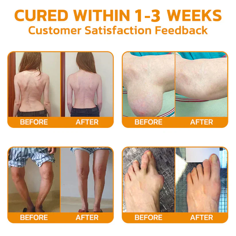 ✅ OFFICIAL STORE: NEGUSY™ Bee Venom Pain Relief Bone Healing Cream 👨⚕️ American Academy of Orthopaedic Surgery (AAOS) certified (Reduces joint swelling, pain, stiffness, redness, warmth, soreness and joint fatigue).