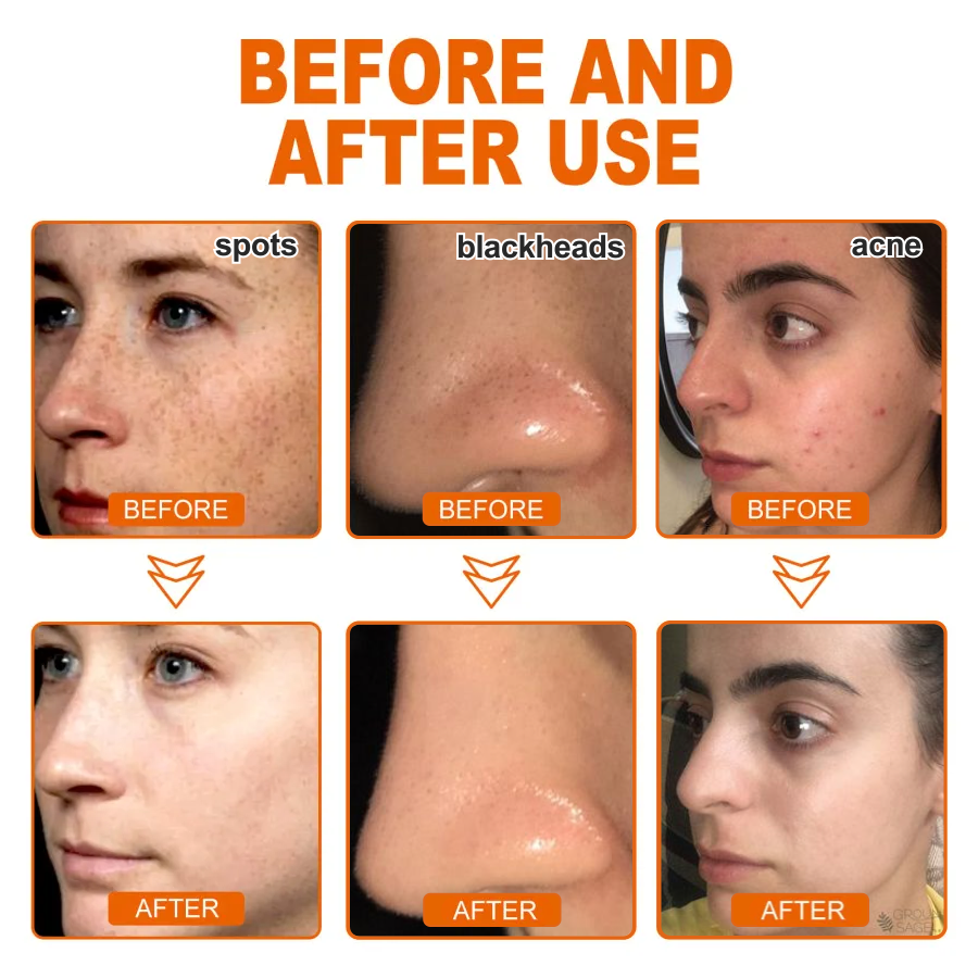🔥[Official Brand Store] JEREMYTIS™ Herbal Spots Peel-Off Facial Mask (✨BUY 2 GET 1 FREE🎁)