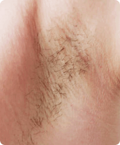 🔥[Official Brand Store] JEREMYTIS™ No-Shave Hair Removal Spray - Sale